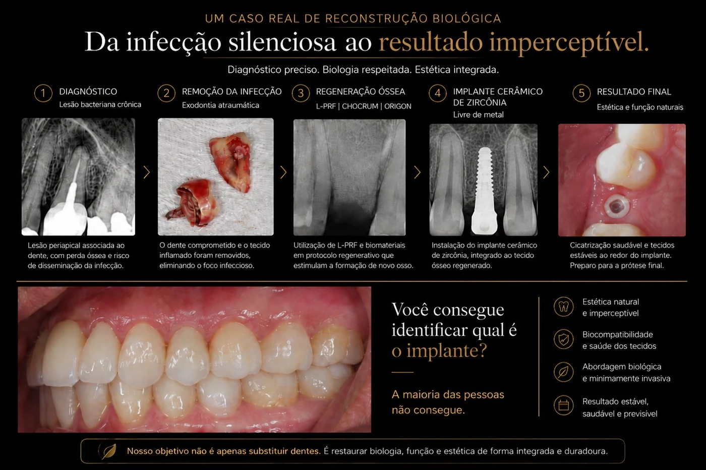 Caso clínico completo — da infecção ao implante cerâmico